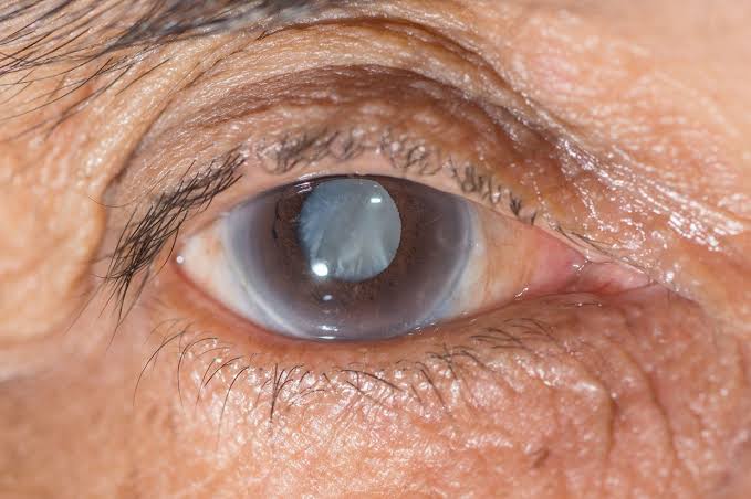  Glaucoma atinge mais de 1 milhão de brasileiros e pode levar a cegueira irreversível