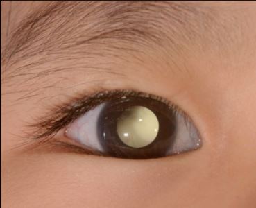  Pediatra afirma que o câncer nos olhos surge mais no primeiro ano de vida