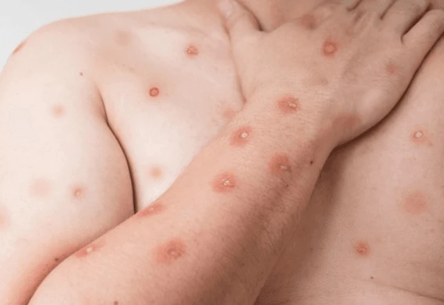 Nova variante da Mpox alerta para vigilância genômica em 2026